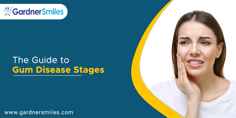 2 Receding Gums Stages