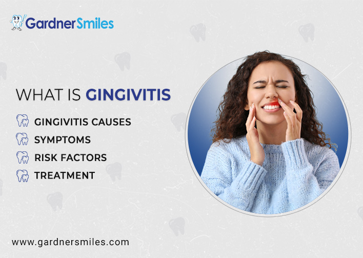 Gingivitis: Causes, Symptoms, Risk Factors & Treatment