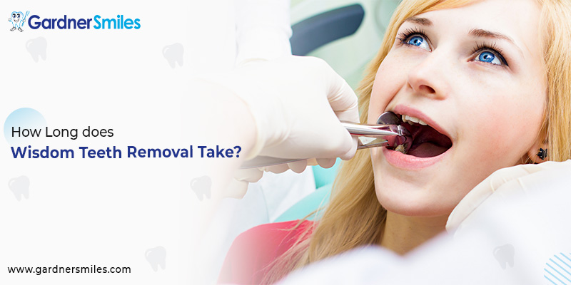 How Long does Wisdom Teeth Removal Take?