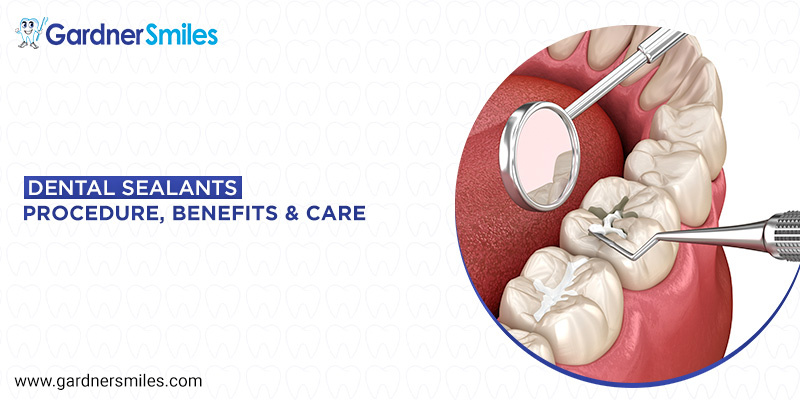 What are Dental Sealants: Procedure, Benefits, and Care