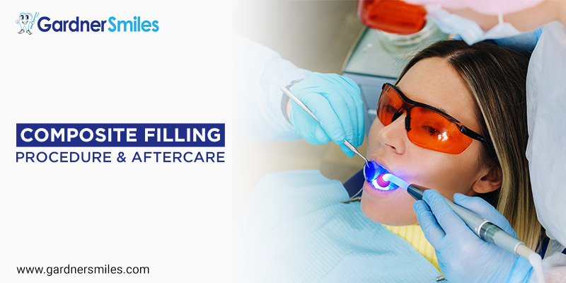 What Is a Composite Filling: Procedure & Aftercare